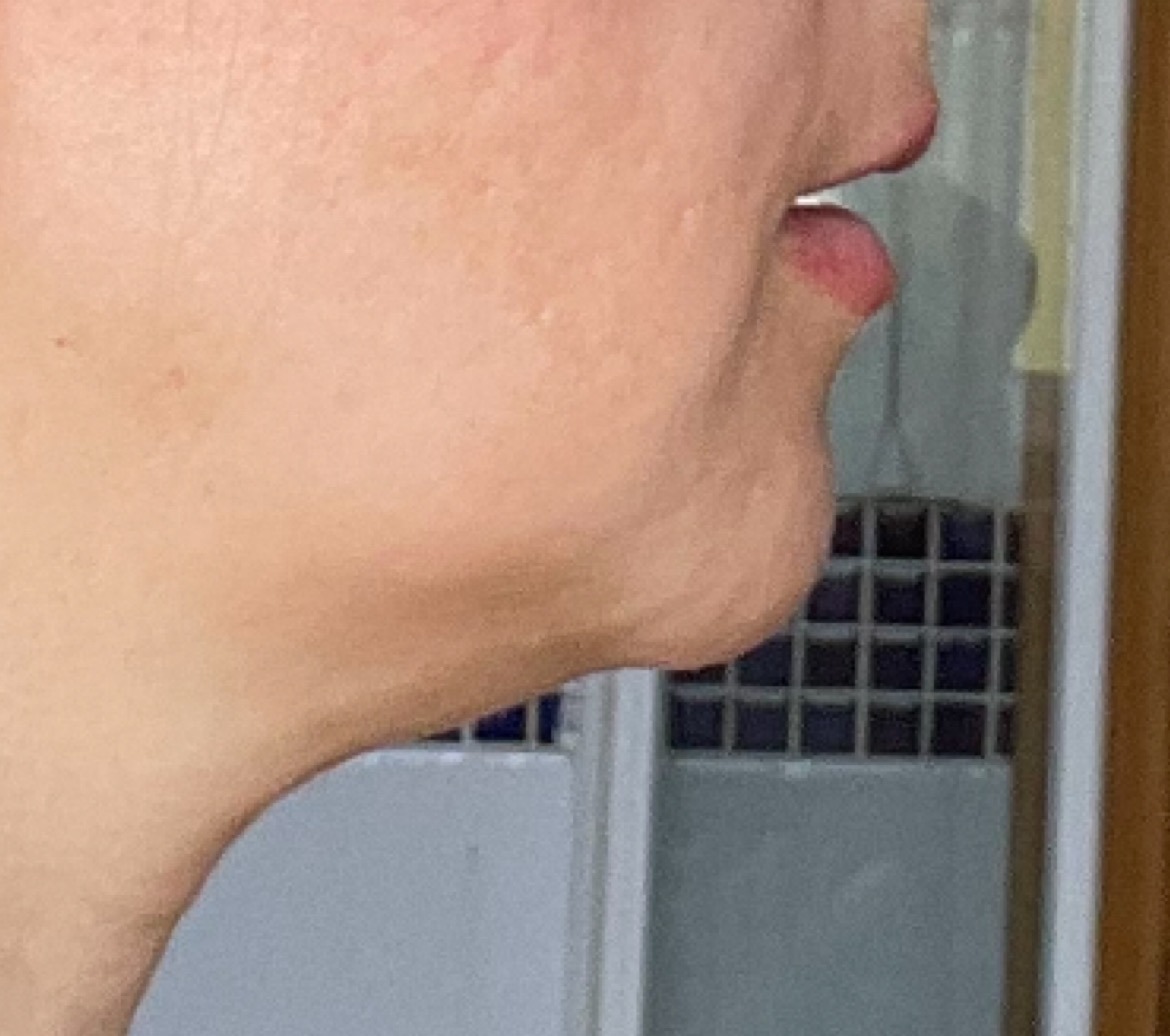 Przed — profil — podbródek i szyja