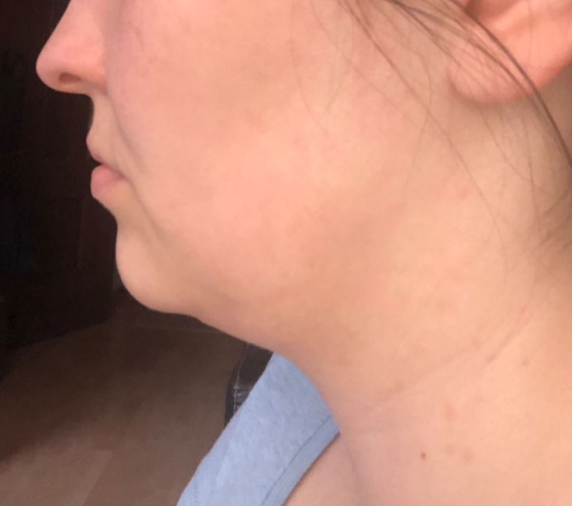 Przed — profil — linia żuchwy
